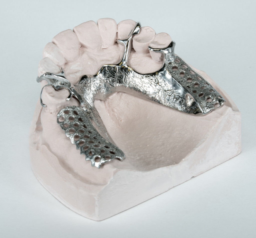 Gedeeltelijke prothese of frameprothese geplaatst in Veenendaal